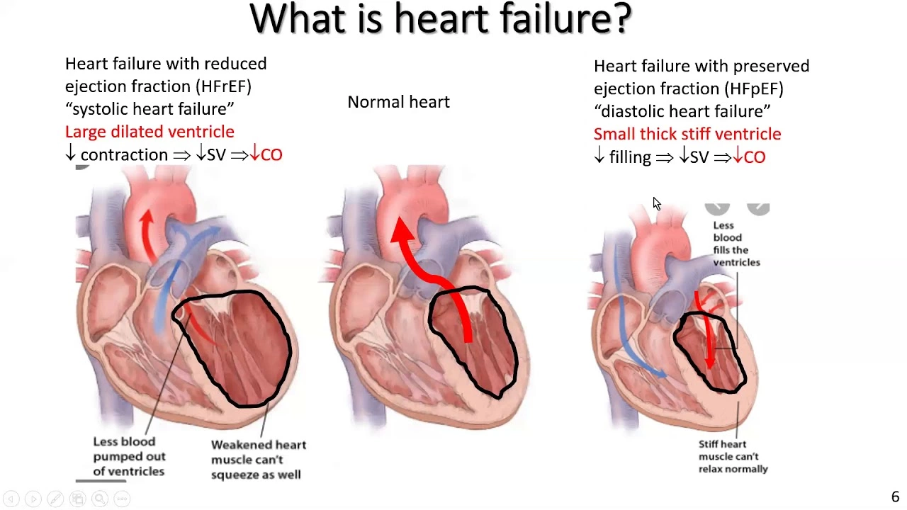 The Impact of Alcohol and Smoking on Chronic Heart Failure